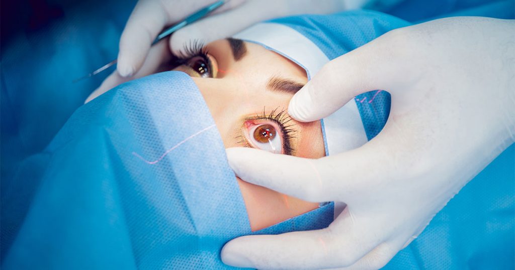 image of a patients eye under a laser machine to show selective laser trabeculoplasty