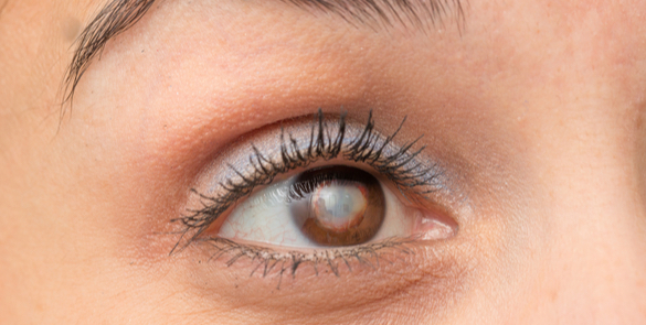 close up image of a female eye with white clouded lens to show cataracts